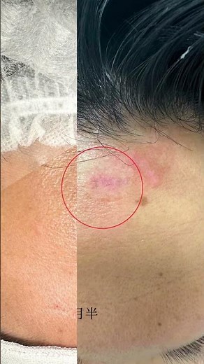 おでこにできた小さい粉瘤の治療と経過