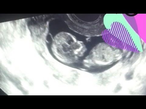 Échographie foetus bébé 12 semaines (12sa) 1er trimestre gyneco explique. 12 weeks