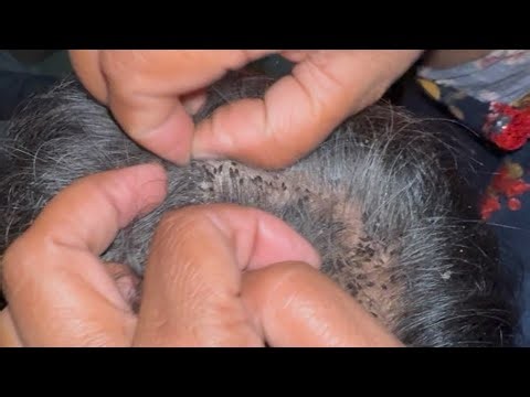 #nitsremoval🔥 Satisfying Lice Removal ASMR 😱 | Wife Deep Cleans Husband’s Hair | Nits Removal EP211