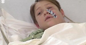 Boy impaled in the face with skewer is miraculously saved