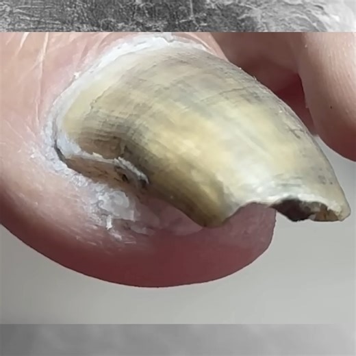 How To Trim Twisted Toenails And Restore Them To Health Step By Step | Expert IQ