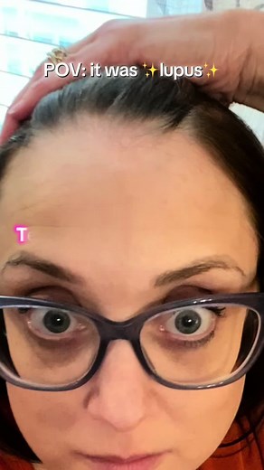 ✨Lupus✨ is an autoimmune disease I didn’t know about before my diagnosis. I often wonder how things might be different if it had been recognized and treated sooner. #lupus #lupusawareness #autoimmunedisease #sle #lupuswarrior