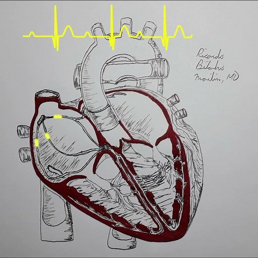 Bloc auriculo-ventriculaire du 1er degré - Animation et ECG
