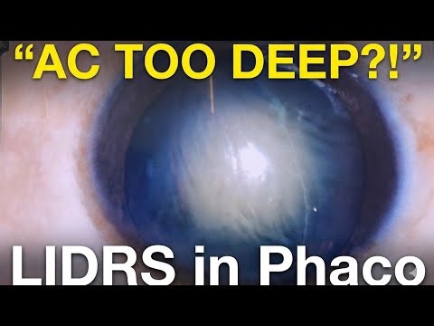 LIDRS during Phacoemulsification | Topical Phaco + Foldable IOL