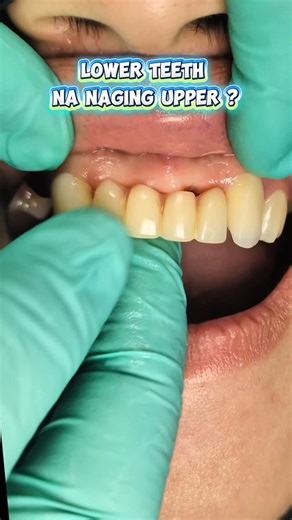 The Dental Center Manila on Instagram: "💎 CORRECTIVE DENTISTRY 💎 Using 💎 CONSERVATIVE DENTISTRY 💎 1. Bakit ganito ang kulay ng ngipin ko? 2. Bakit laging nalalaglag ang fixtures ko? 3. May pag-asa ba pa ang teeth ko? 4. Ayoko ng jacket crowns. May iba pa ba? 5. I need to change my smile. 6. Gusto ko lang natural white lang. 7. Takot ako sa dentista. 8. Takot ako magpabunot. 9.Paano ba hindi matanggal ang VENEERS ko? 10. Paano magkakasya ang budget ko? CORRECTIVE DENTISTRY helps us figure out