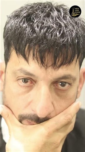 Hair Patches For men: Before & After Transformation by new hair image #hairpatch