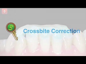 Treatment of Class I Anterior Crossbite with the Damon Ultima System |【Chris Chang Ortho】CC852