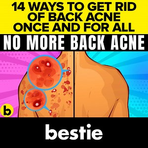 14 Ways To Get Rid Of Back Acne Once And For All ✅ Sources: https://pastebin.com/aYnjXkEh #Bestie #BestieVideos #BestieHealth #FoodsThatStayLongestInThePantry #GetRidOfBacneFast #GetRidOfBackAcne #BackAcneRoutine #BestAcneBodyWash #14WaysToGetRidOfBackAcne #BestieBeautyTips #SkincareTips #ClearSkin #AcneSolutions #BeautyHacks #AcneTreatment #BackAcneRemedy #SkinCareRoutine #AcneFree #HealthySkin #BeautySecrets #SkinGoals #ClearComplexion #GlowingSkin #SkinCareProducts #Dermatology #BeautyRoutine