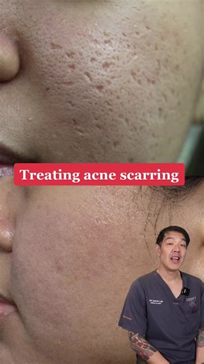 Using TCA paint and Pico Lasers to restore acne scarring w/ Dr Davin Lim #dermatologist #acnetreatment #acnescars #skincare