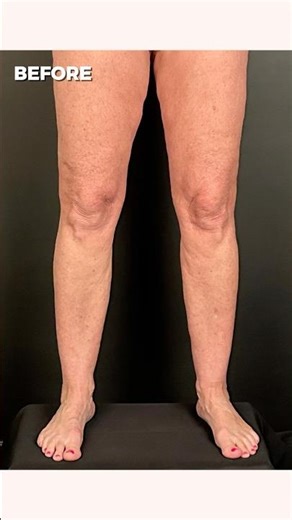 She Was Told to “Just Lose Weight”… But This Was Lipedema