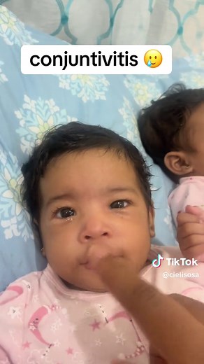 Conjuntivitis en Bebés: Tratamiento y Cuidados Esenciales