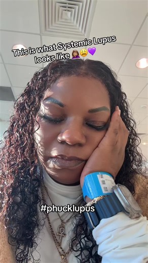 Systemic Lupus problems. #lupus #lupuswarrior #lupussurvivor #lupusawareness
