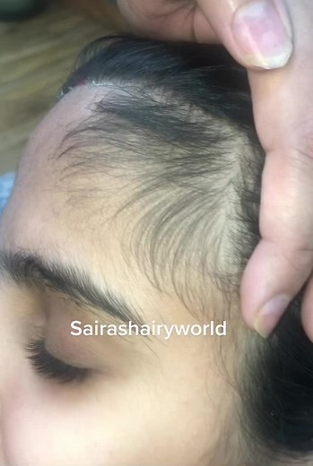 Hair Waxing for Forehead Hair Removal