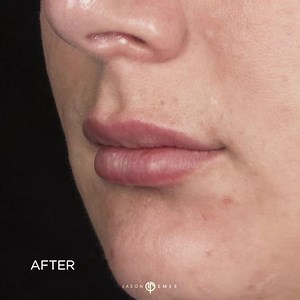 Lip Augmentation using Fillers