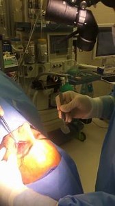 Tripod Fracture Repair Surgery and Results