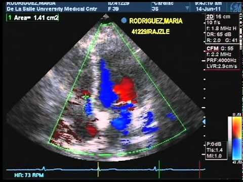 Echocardiography and Color Flow Doppler