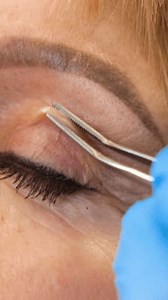 Specialized Eye Lift Procedure That Demonstrates Stock Footage Video (100% Royalty-free) 3789890079 | Shutterstock