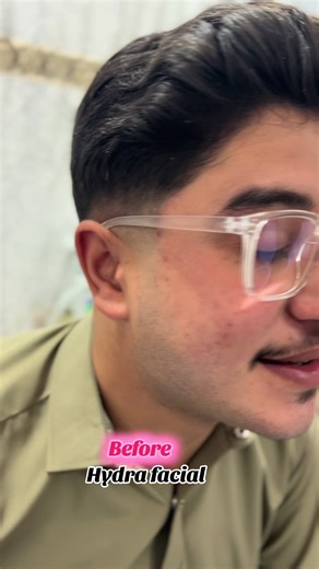 Amazing Hydra Facial Results You Need to See