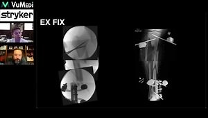 When to Ex-Fix vs. Definitively Fixate