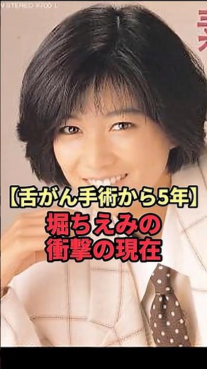 [5 years after tongue cancer surgery] Chiemi Hori's shocking current situation