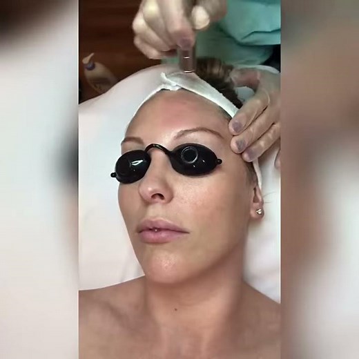 Microdermabrasion Treatment for Facial Rejuvenation