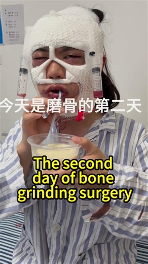 Changes after bone reduction#整形#变美#Bone grinding