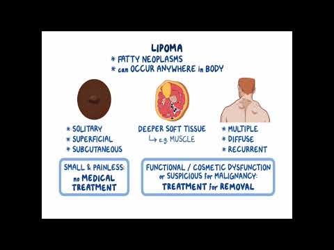 Lipomas