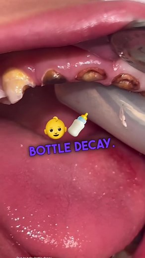 Baby bottle 🍼 decay destroyed the baby 🦷! Top front 4 were infetced, had to be removed. All other top teeth were saved with silver crowns #dentist #teeth #tooth teeth cleaning plaque removal calculus removal on teeth rotten teeth tooth decay extraction abscess tooth removal cavity infection hole in tooth toothpaste teeth implants teeth care nursing caries baby teeth cavities