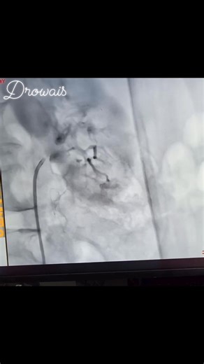 𝗥𝗲𝗻𝗮𝗹 𝗮𝗿𝘁𝗲𝗿𝘆 𝗮𝗻𝗴𝗶𝗼𝗽𝗹𝗮𝘀𝘁𝘆 | Practical Interventional Cardiology