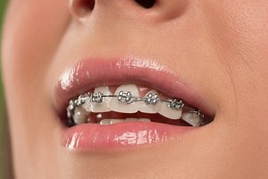 Types of Braces -- Trust Your Orthodontist to Help you Choose