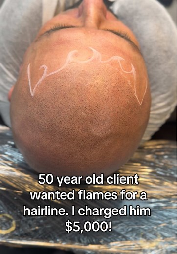 Hairline Transformation: Flames for Age-Appropriate Look