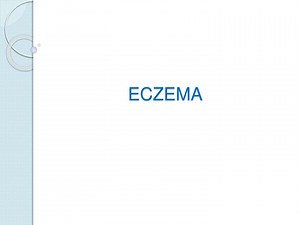 ECZEMA - SlideServe