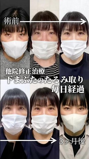 【40代クマ修正治療】#クマ取り #クマ治療 #目の下のクマ #ダウンタイム #rootsclinic