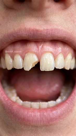 Precision Meets Artistry: The Silicone Key Technique Restoring a fractured central incisor isn’t just about filling a gap; it’s about reconstructing biomechanics and optical harmony. Why use a Silicone Index? By creating a mold from a diagnostic wax-up (or the original tooth), we can: 1️⃣ Establish the exact palatal wall thickness. 2️⃣ Ensure perfect incisal edge positioning. 3️⃣ Control the layering of composite increments to mimic natural enamel and dentin. In this case, notice how the putty i