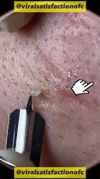 #acne #pimple #pimples #blackhead #blackheads #satisfying