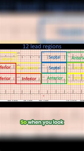 Understanding EKG readings for myocardial infarction patterns | Aaron Costantino posted on the topic | LinkedIn