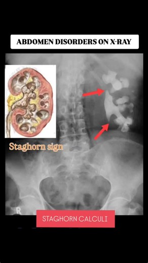RK NURSE'S HUB | The "staghorn sign" on an abdominal X-ray refers to a large, branching kidney stone (staghorn calculus) that fills the entire renal pelvis... | Instagram