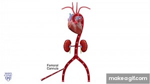 ECMO on Make a GIF