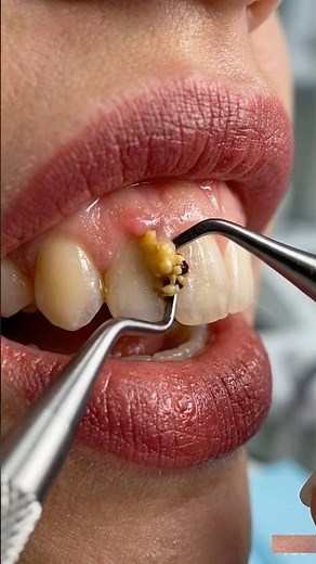 Deep Caries to Veneers: Anterior Tooth Transformation | #dentist #toothcraft #asmr #satisfying