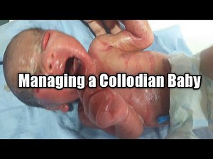 How to manage a Collodian Baby | Mother's Guide