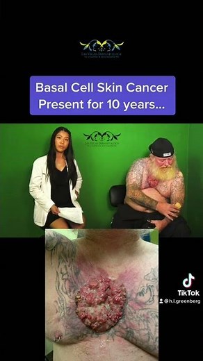 Massive Basal Cell Skin Cancer present for 10 years! Interview at Las Vegas Dermatology