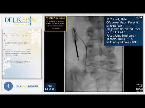 L4-L5 PLASMA RHIZOTOMY - LIVE - Laser Spine Surgery
