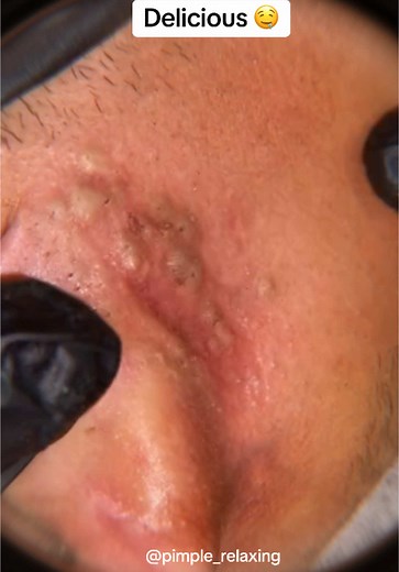 Comment for part 2 #blackhead #supersatisfying #pimplepop #extractionsatisfaciton