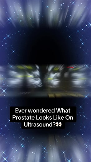 The prostate is a small gland found only in men, located just below the bladder and surrounding the urethra, the tube that carries urine out of the body. Because of its location, changes in prostate size can directly affect urination. As men age, the prostate commonly enlarges, which can lead to urinary symptoms. Ultrasound helps visualize the prostate and its relationship to the bladder without radiation or invasive testing. Understanding where the prostate sits anatomically helps explain why p