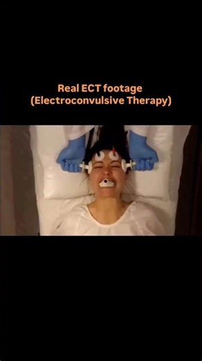 Electroconvulsive Therapy (ECT)||🧠😳 #ECT #ElectroconvulsiveTherapy #MentalHealth #psychiatry