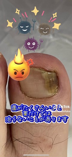 爪水虫の治し方と削り方