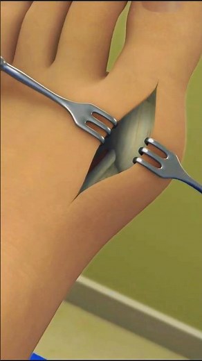 Bunion Surgery Explained: What is bunionectomy #medical3danimation