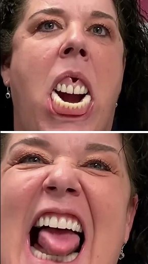 old loose denture vs brand new suction denture | #shorts