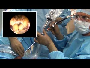 Transurethral Rigid Ureteroscopy • Video • MEDtube.net