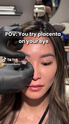 Think of it like stem cell therapy.. using amniotic membrane from the placenta. It’s used to heal the eye and treat dry eyes 👀 . It’s also used for corneal abrasions, infections, ulcers, and scars. Would you try it? 📍 Treatment available at text 646-791-6467 to book. #stemcell #prokera #dryeyes #longevity #eyecare